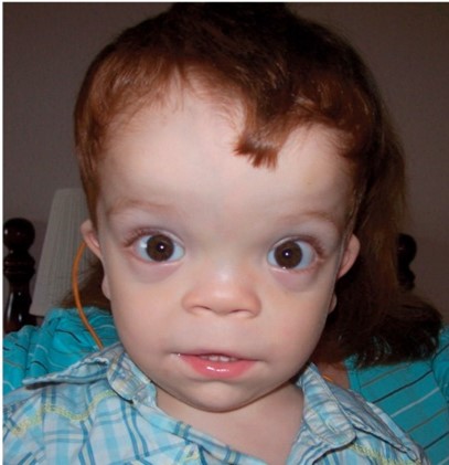 maladies_rares_en_pediatrie